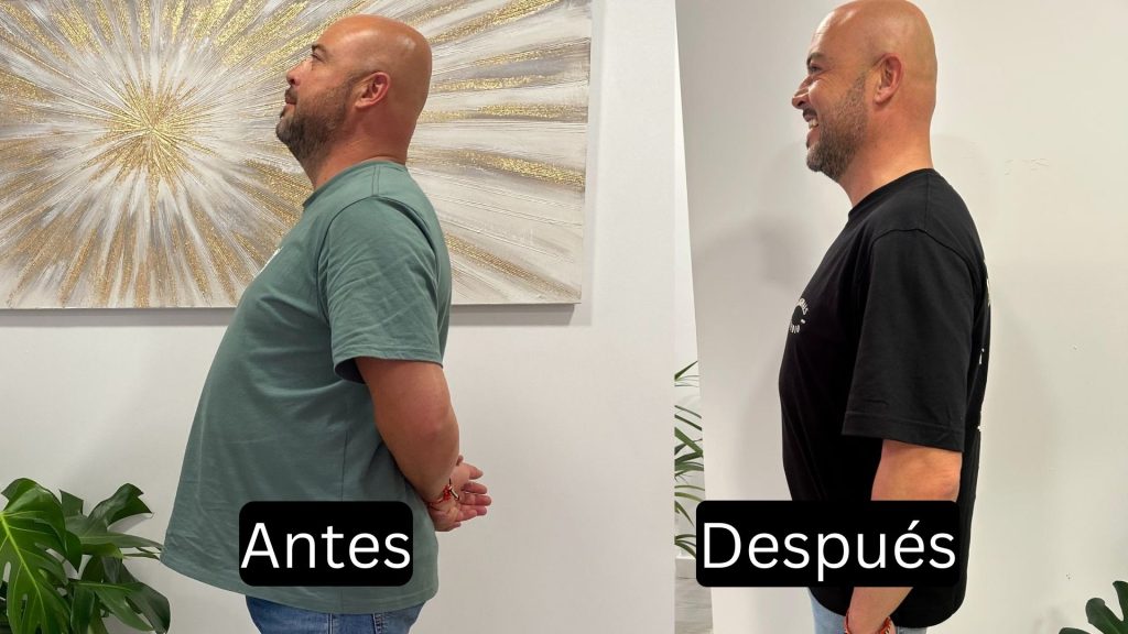 Comparativa de resultados de pérdida de peso con balón gástrico en Clínicas Kiharu: antes y después del tratamiento