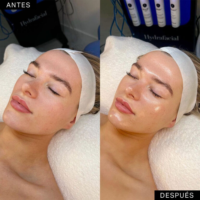 Hydrafacial-Antes-Despues-2-768x768